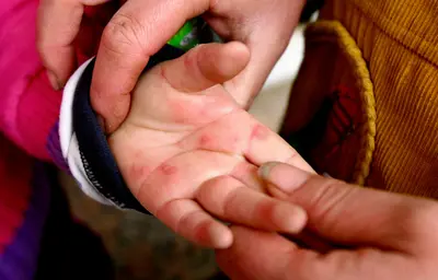Explainer: why children are at risk of hand, foot and mouth disease