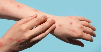 Bay residents urged to be on high alert for signs of Mpox